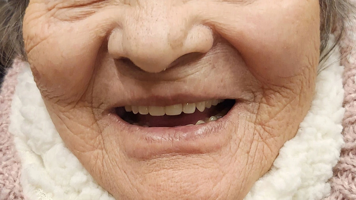 Caso clínico de restauración dental 1